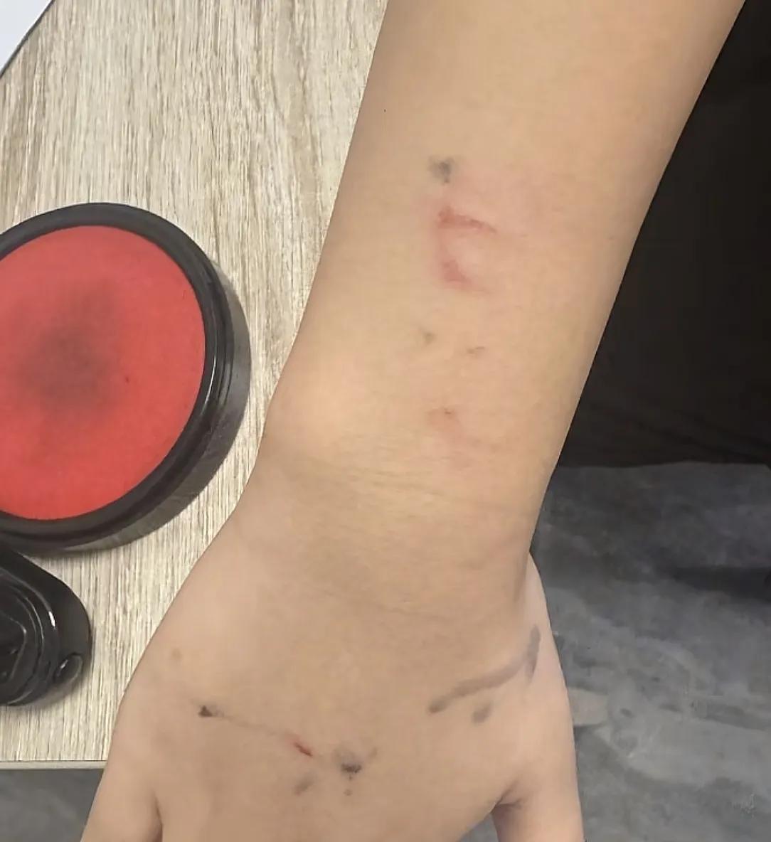 女子外卖代送被大妈抢单，手臂被掐伤！是个惯犯，年纪大管不了  第6张